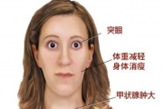 身体出现这9个异常，小心是甲状腺出了问题！